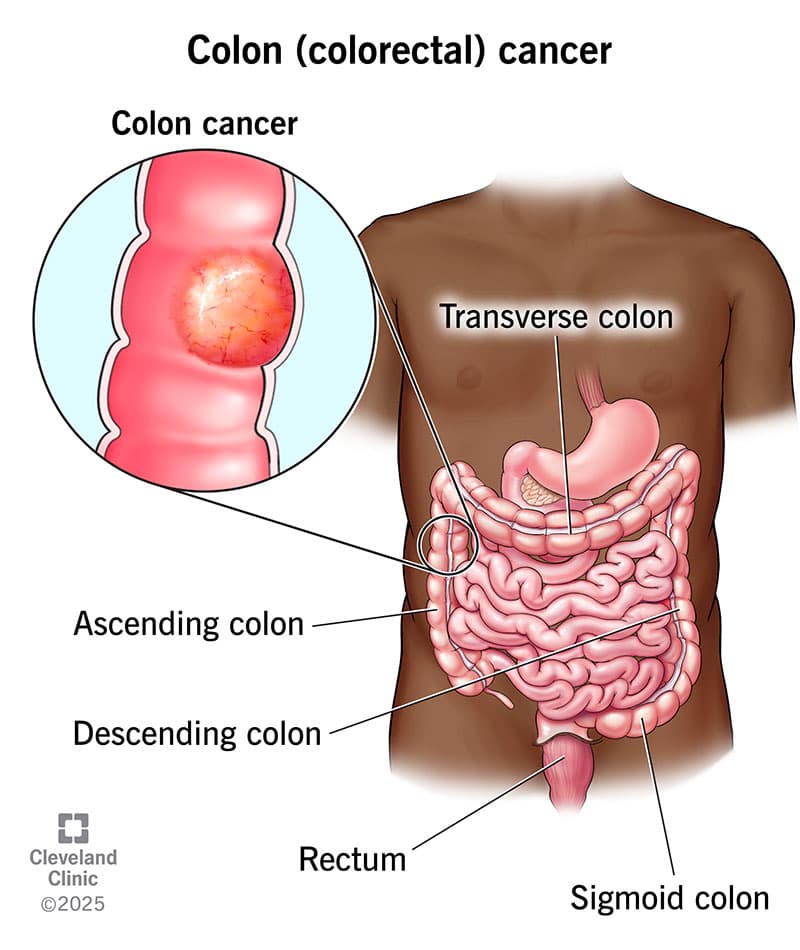 Metabolomics colorectal cancer analysis project preview